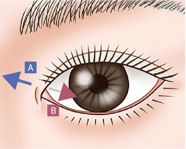 蒙古襞形成の方向 A・B